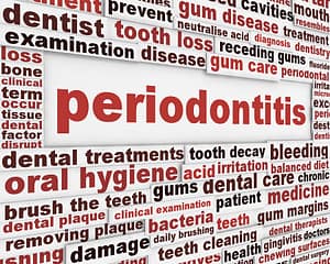 what are the signs and symptoms of periodontal disease