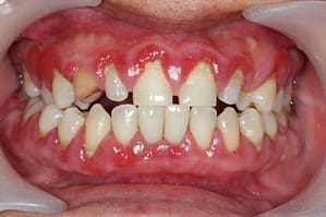 swollen gums treatment