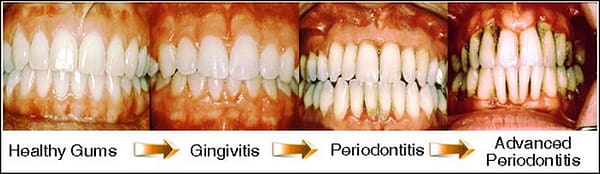 how to reverse periodontal disease naturally